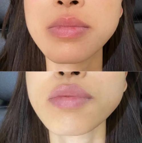 مدل ژل لب برای صورت گرد قبل و بعد از تزریق