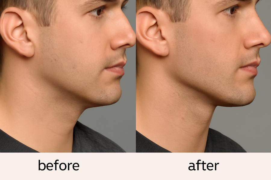زاویه سازی فک مردانه در کرج قبل و بعد