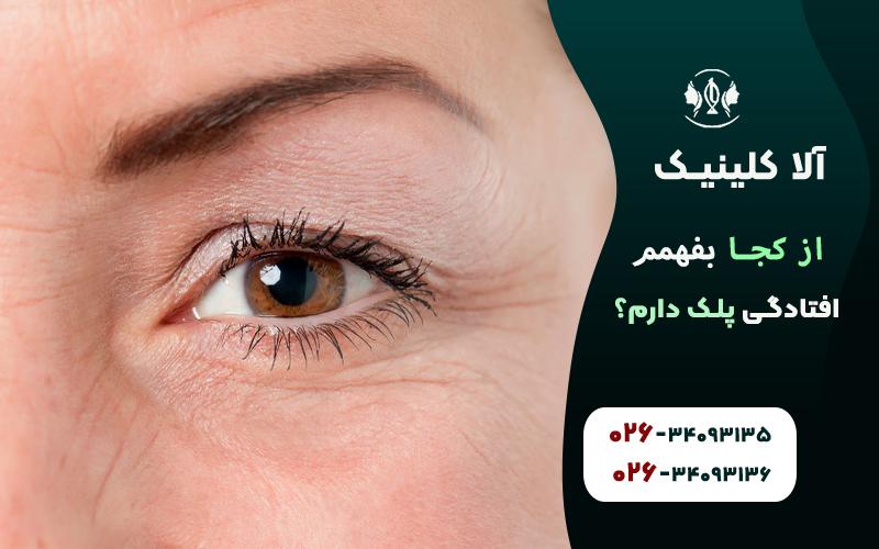 از کجا بفهمم افتادگی پلک دارم