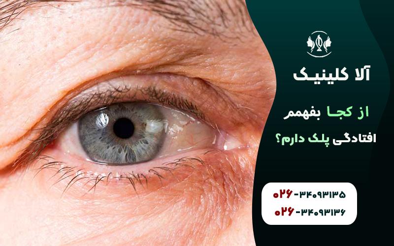 از کجا بفهمم افتادگی پلک دارم