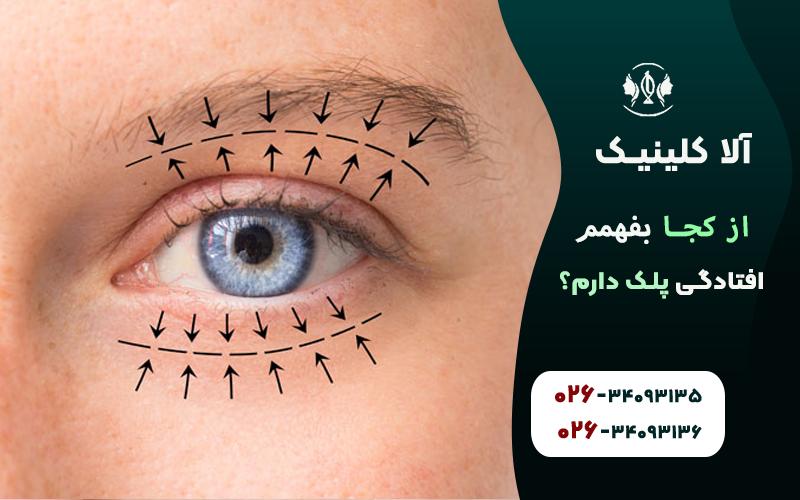 برای تشخیص قطعی، پزشک با اندازهگیری فاصله بین مردمک و لبهی پلک (MRD1) مشخص میکند که آیا افتادگی