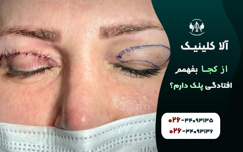 از کجا بفهمم افتادگی پلک دارم