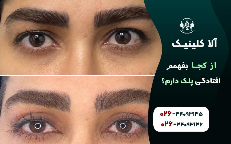 از کجا بفهمم افتادگی پلک دارم