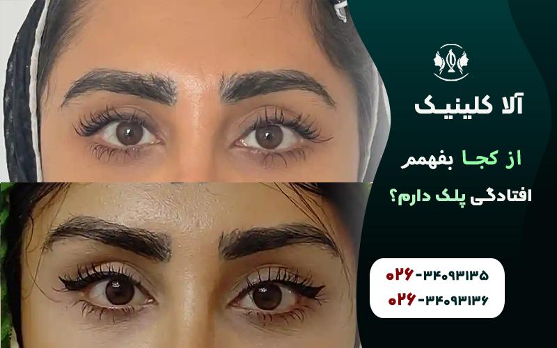 از کجا بفهمم افتادگی پلک دارم