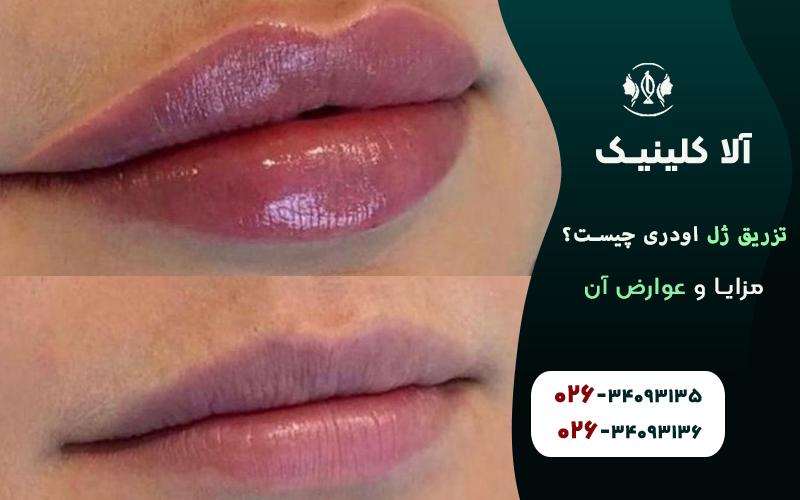 تزریق ژل اودری چیست؟ مزایا و عوارض آن