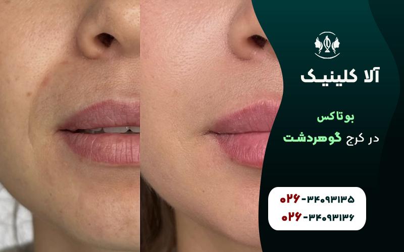 کلینیک تزریق بوتاکس در گوهردشت کرج