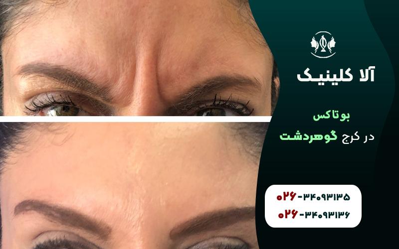 کلینیک تزریق بوتاکس در گوهردشت کرج