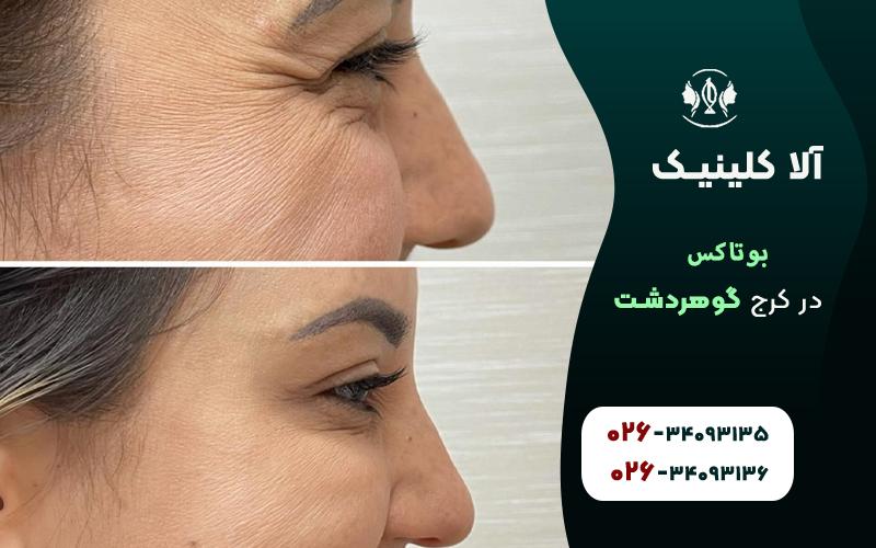بهترین کلینیک تزریق بوتاکس در گوهردشت کرج