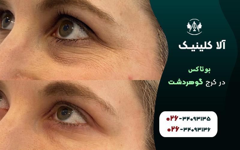 تزریق بوتاکس در گوهردشت کرج