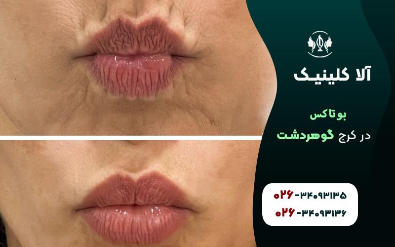 کلینیک تزریق بوتاکس در کرج