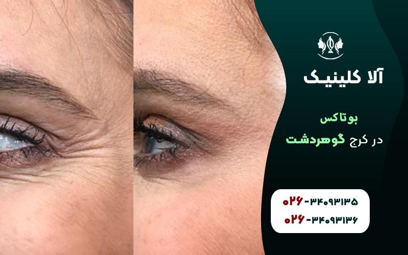 بوتاکس در گوهردشت کرج