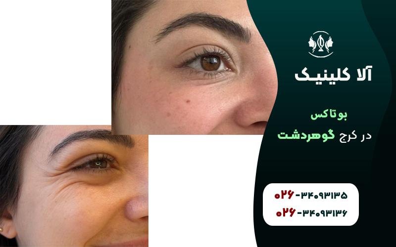 بوتاکس در کرج