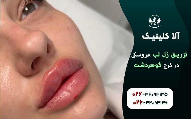 تزریق ژل لب مدل روسی عروسکی