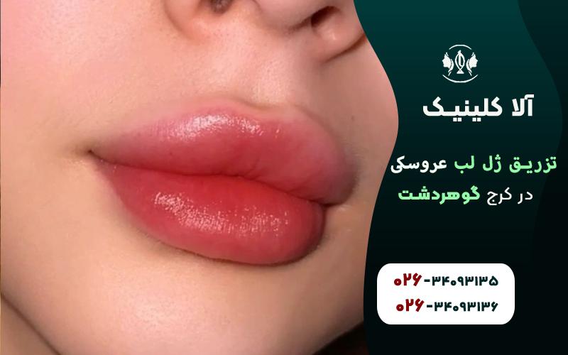 تزریق ژل لب مدل عروسکی