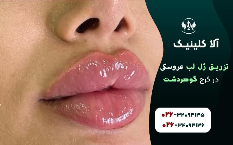 تزریق ژل لب مدل روسی عروسکی
