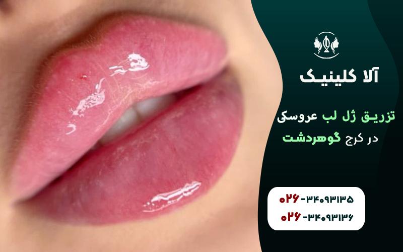 تزریق ژل لب مدل روسی عروسکی