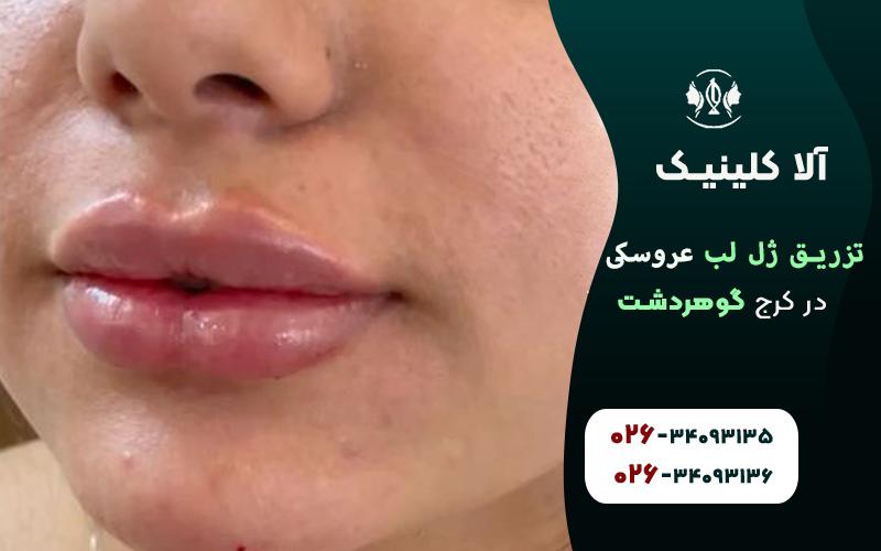 تزریق ژل لب مدل عروسکی طبیعی