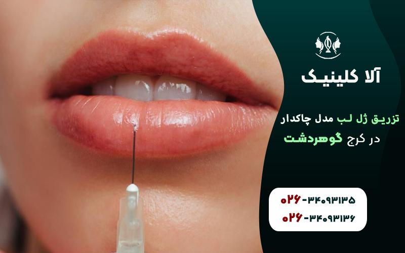 تزریق ژل لب مدل طبیعی چاک دار