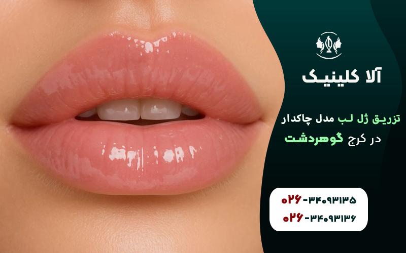 تزریق ژل لب مدل قلوه ای چاک دار