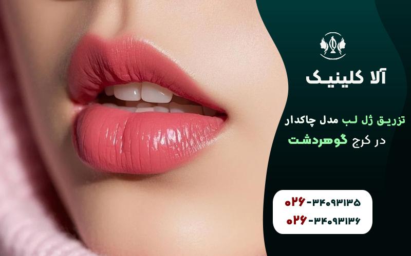 تزریق ژل لب مدل چاک دار