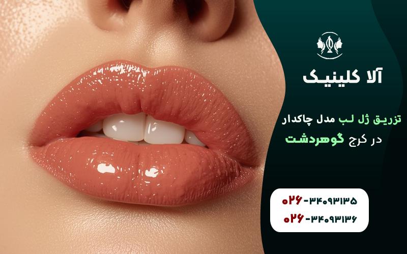 ژل لب مدل روسی چاکدار