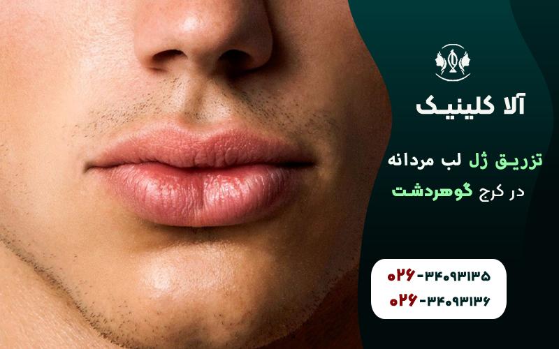 بهترین کلینیک تزریق ژل لب مردانه کرج