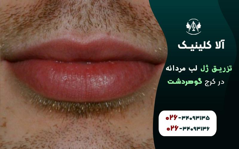مدل ژل لب مردانه کرج