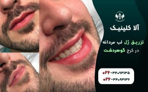 تزریق ژل لب مردانه کرج