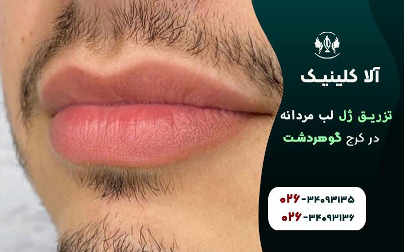 تزریق ژل لب مردانه کرج