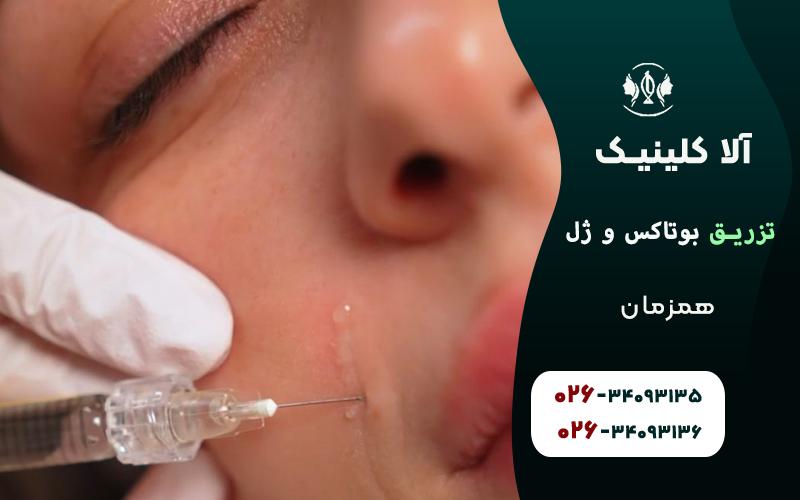 تزریق بوتاکس و ژل همزمان + سوالاتی که دارید!