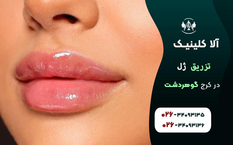 تزریق ژل لب در کرج