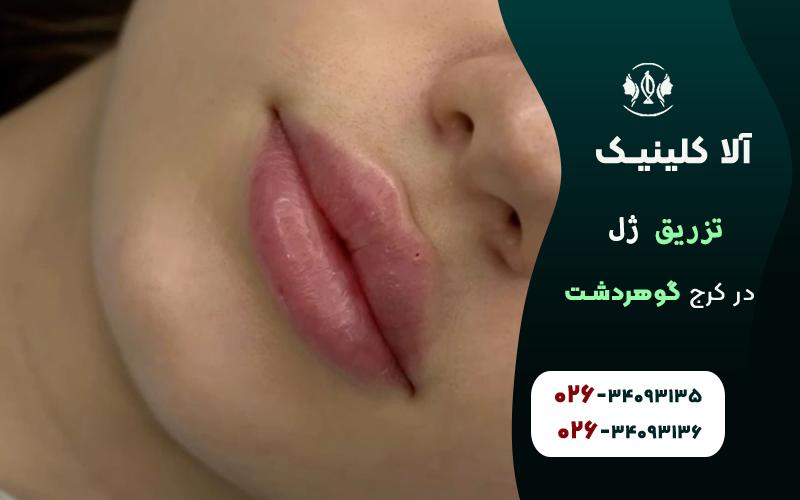 کلینیک تزریق ژل لب در کرج