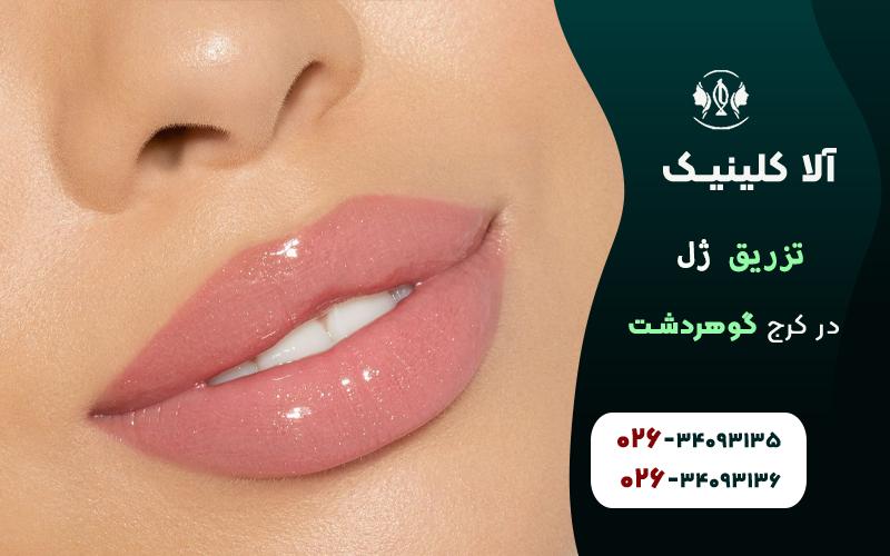 تزریق ژل لب در کرج گوهردشت