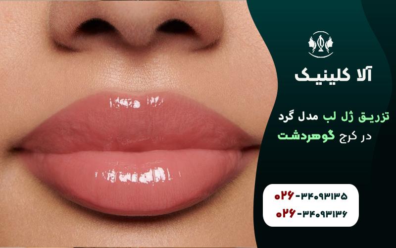 تزریق ژل لب مدل گرد در کلینیک آلا کرج