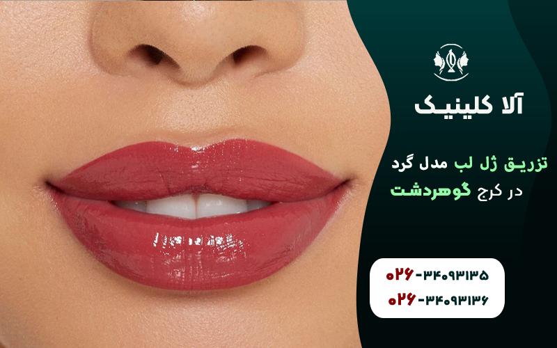 تزریق ژل لب مدل گرد در کلینیک آلا کرج