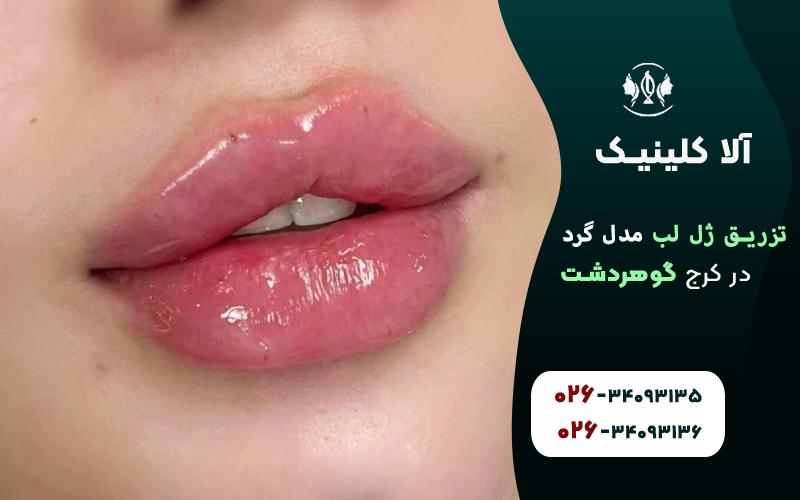 تزریق ژل لب مدل گرد در کرج