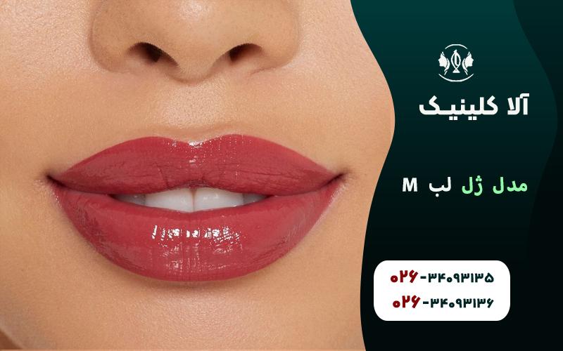 تزریق ژل لب مدل M