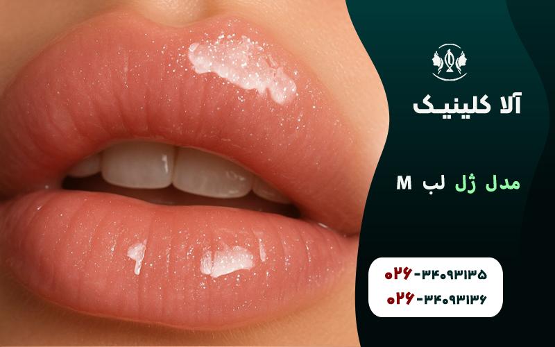 تزریق ژل لب مدل M