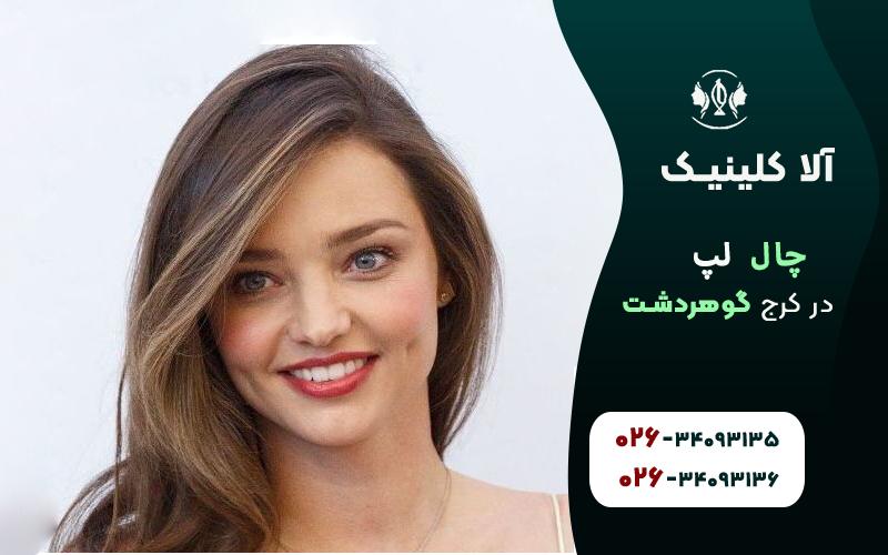 چال لپ در کرج