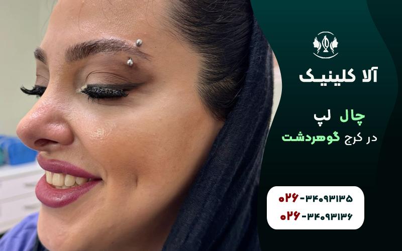چال لپ در کرج