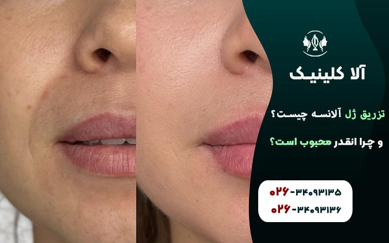 تزریق ژل الانسه