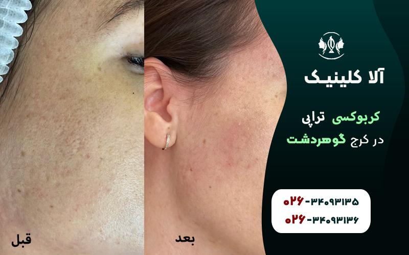 کربوکسی تراپی قبل و بعد در کلینیک آلا کرج
