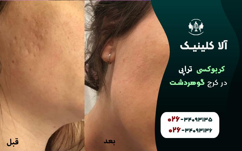 کربوکسی تراپی قبل و بعد در کلینیک آلا کرج
