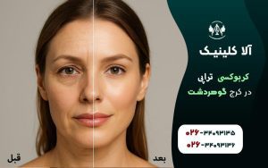 کربوکسی تراپی در کرج