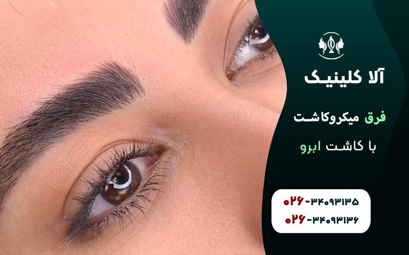 فرق میکرو کاشت با کاشت ابرو