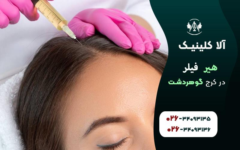 قیمت هیر فیلر کرج