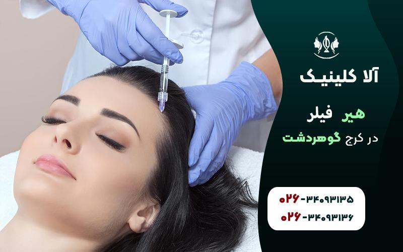 هیر فیلر در کرج