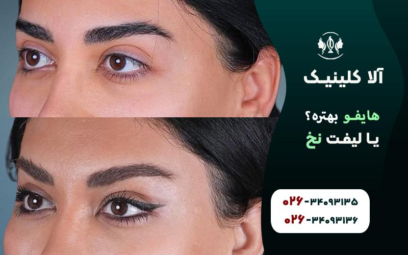 هایفو بهتره یا لیفت با نخ