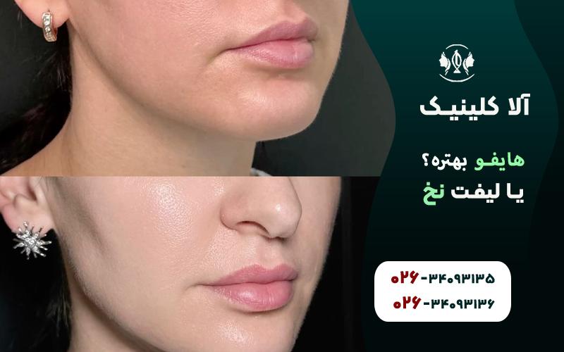 هایفو بهتره یا لیفت با نخ