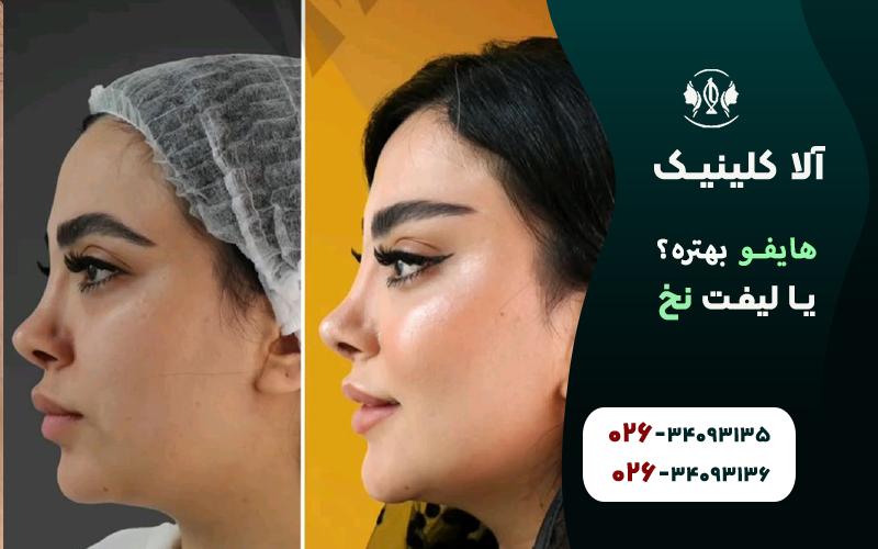 هایفو بهتره یا لیفت با نخ
